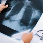 У трьох громадах Херсонщини працюватиме мобільний рентгенологічний кабінет