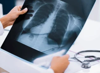 У трьох громадах Херсонщини працюватиме мобільний рентгенологічний кабінет